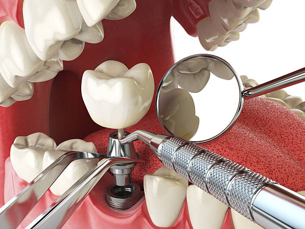 Best Emergency Tooth Extraction in Plainwell, MI
